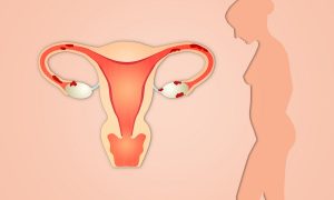 Endometrioza