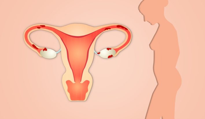 Endometrioza