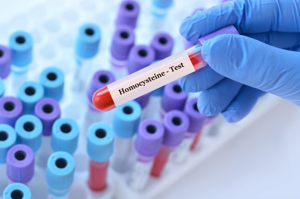 hiperhomocysteinemia