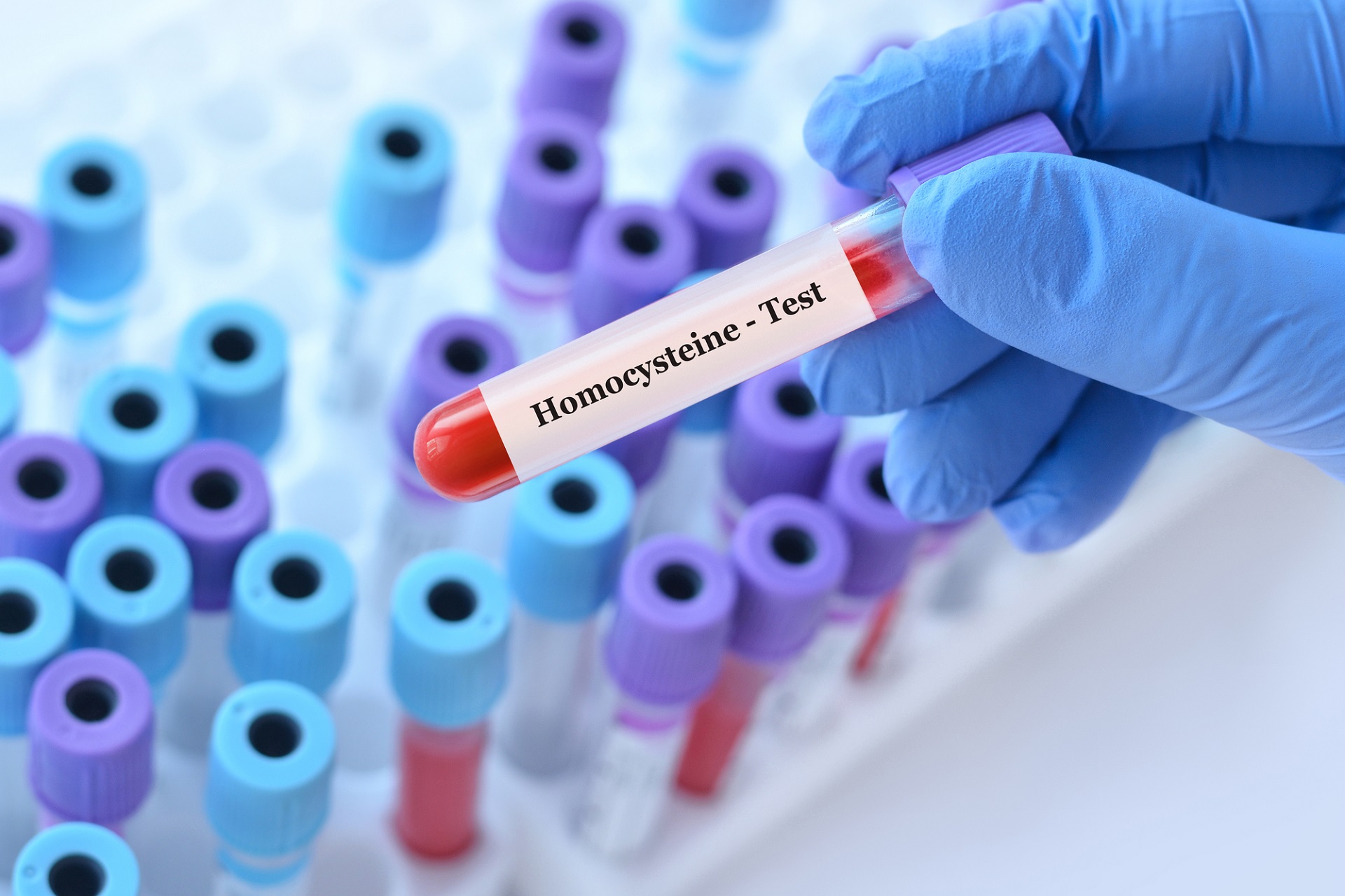 hiperhomocysteinemia